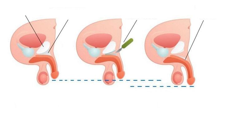 mărirea penisului după operație